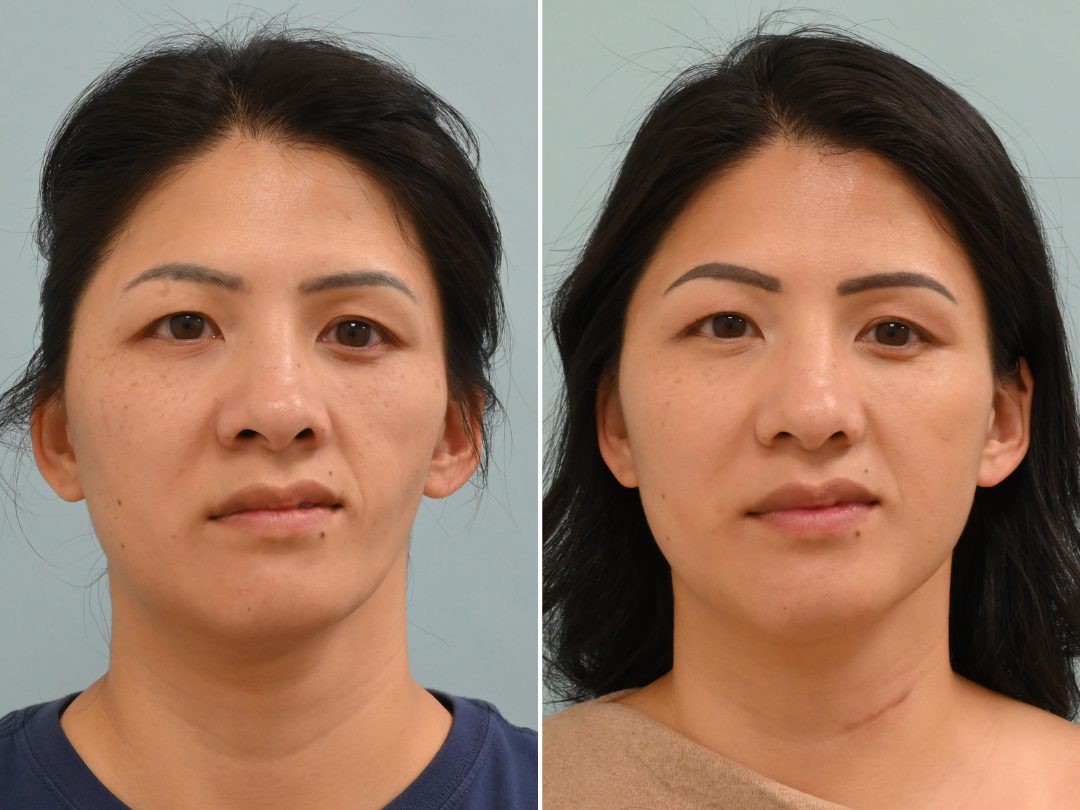 Cấy mỡ tự thân: Phương pháp trẻ hoá của kỷ nguyên không dấu vết