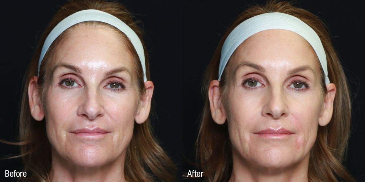 Cấy mỡ tự thân: Phương pháp trẻ hoá của kỷ nguyên không dấu vết